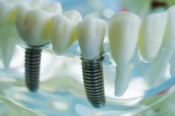 How Dental Implants Improve Oral Health And Function